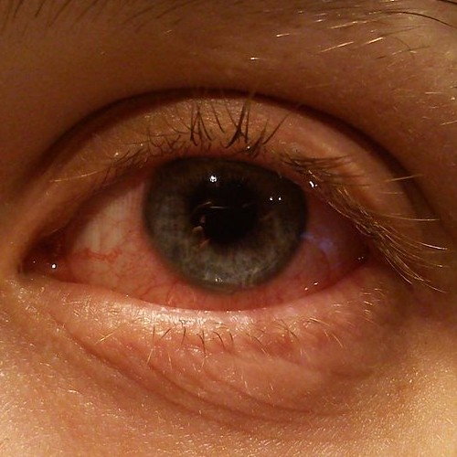 conjunctivitis